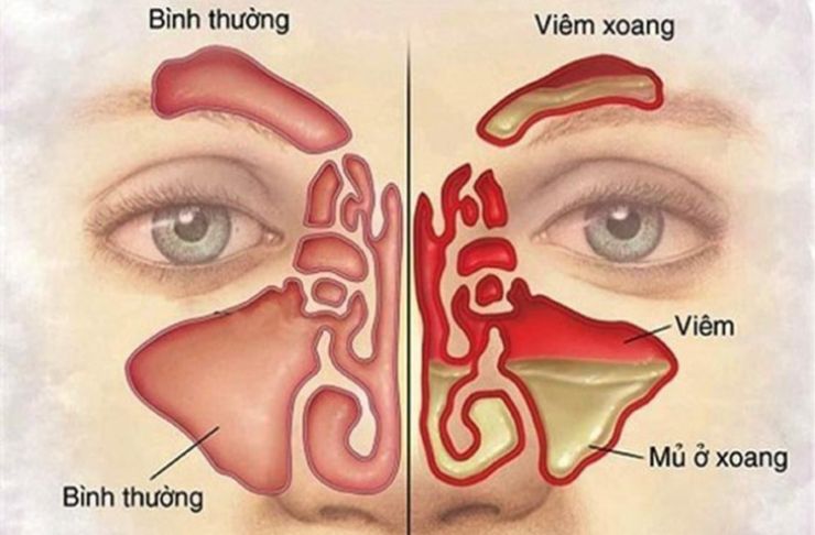 Khi n&agrave;o cần đi kh&aacute;m vi&ecirc;m xoang?