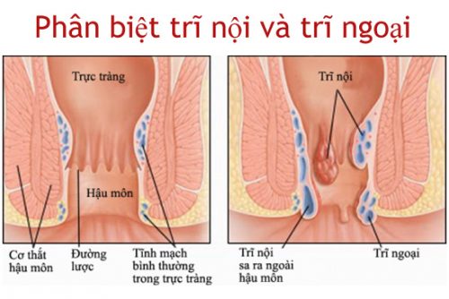 Trĩ ngoại là gì? Dấu hiệu nhận biết sớm