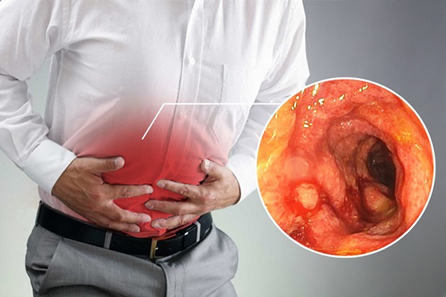 Điều trị viêm đại tràng mãn tính ở Hà Nội bác sĩ giỏi: Nên đến đâu?