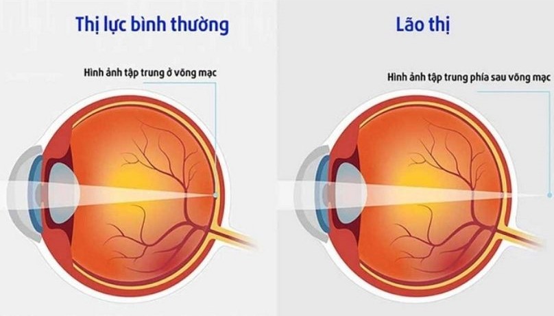 Lão thị là gì?