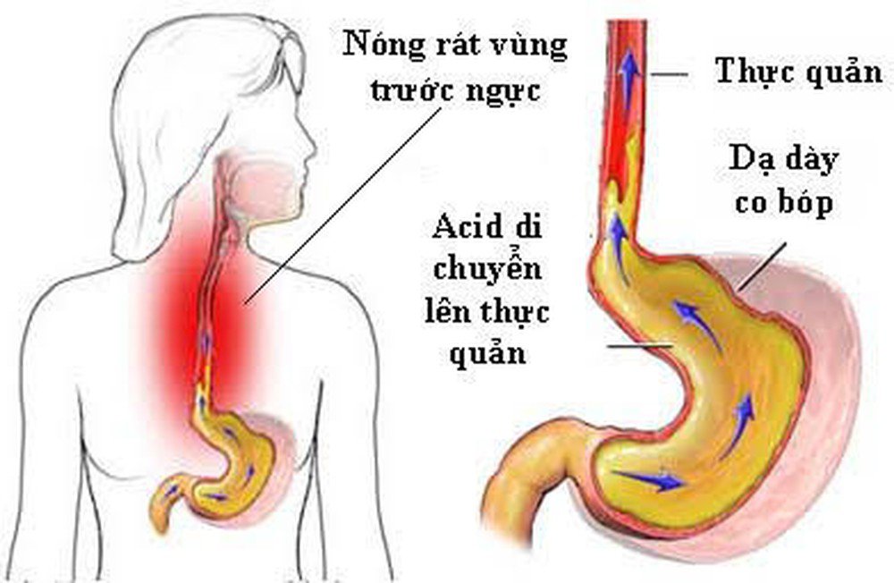 Điều trị trào ngược dạ dày thực quản ở TP.HCM – Địa chỉ nào uy tín?