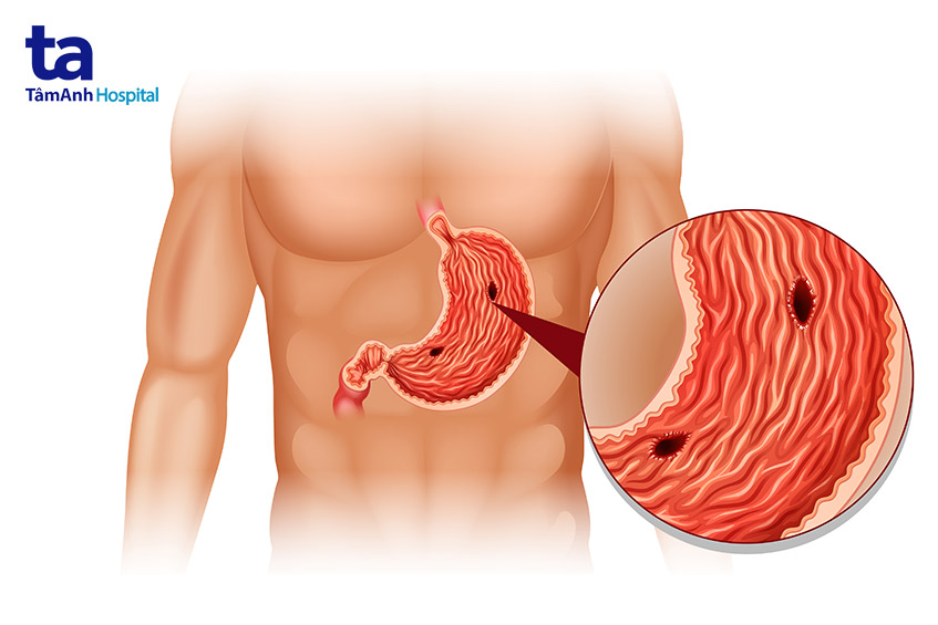Viêm loét dạ dày – tá tràng là gì?