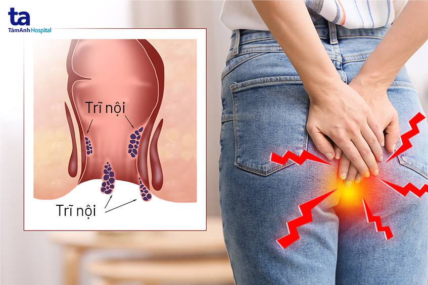 Bệnh trĩ nội là gì?