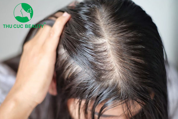 Rụng tóc nội tiết là gì?
