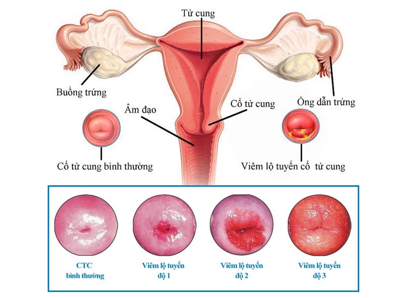 Viêm lộ tuyến cổ tử cung là gì?