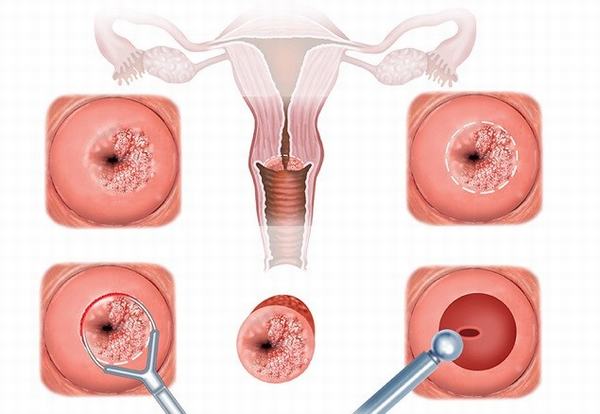Các phương pháp điều trị viêm lộ tuyến cổ tử cung hiện nay
