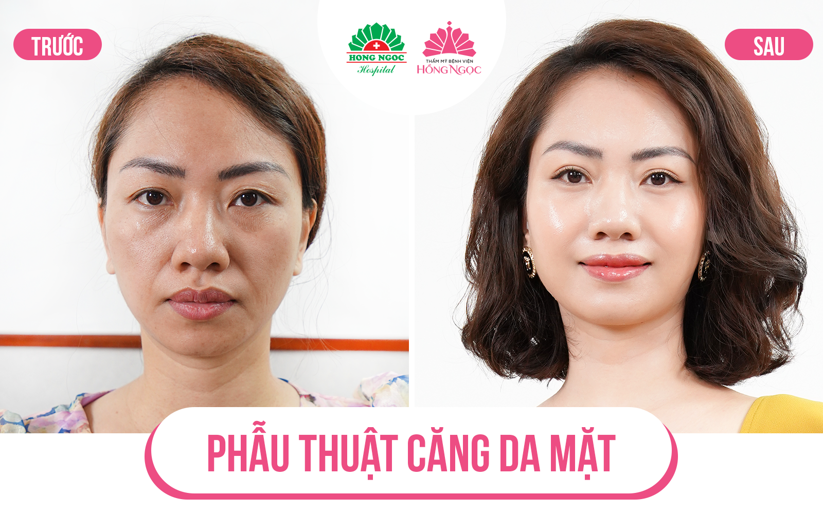 Căng da mặt không phẫu thuật là gì?