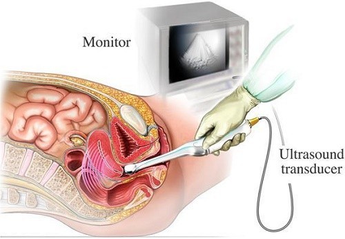 Siêu âm đầu dò âm đạo là gì?
