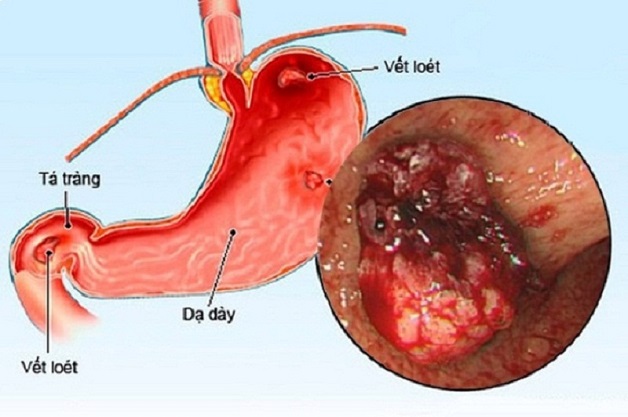 Viêm dạ dày mãn tính là gì?
