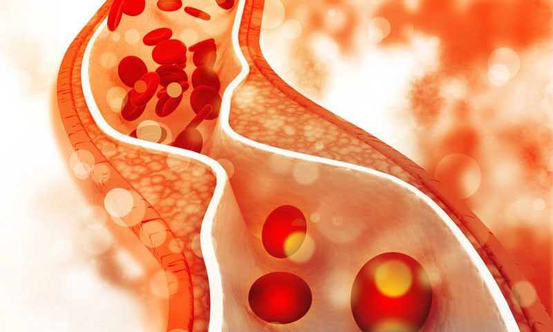Những biến chứng nguy hiểm do rối loạn lipid máu
