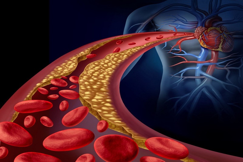Rối loạn lipid máu là gì?