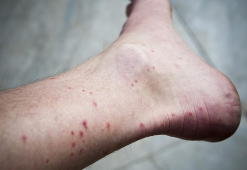 Các phương pháp xét nghiệm sốt xuất huyết thường được sử dụng