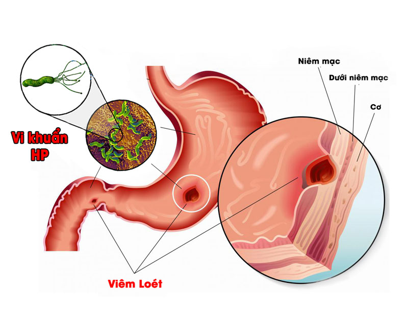 Đau dạ dày: Cảnh báo sớm từ những triệu chứng thường gặp
