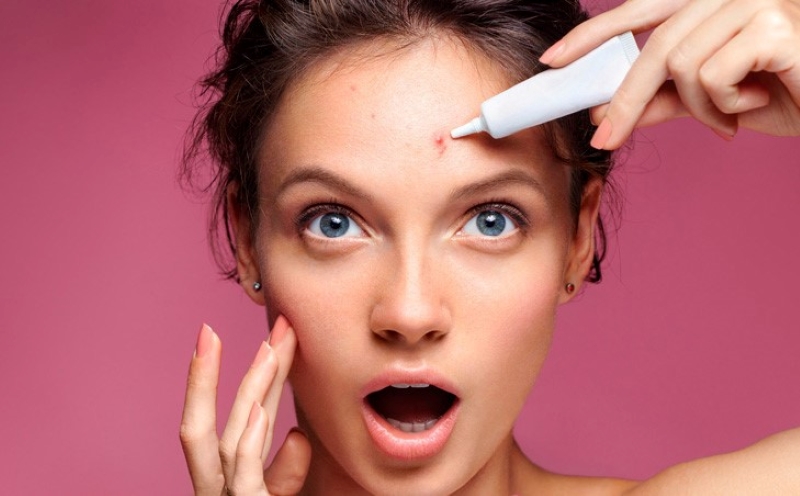 Mụn – Vấn đề da liễu không chỉ của tuổi dậy thì