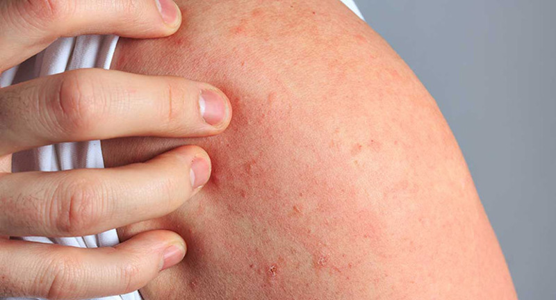 Ngứa da kéo dài là gì?