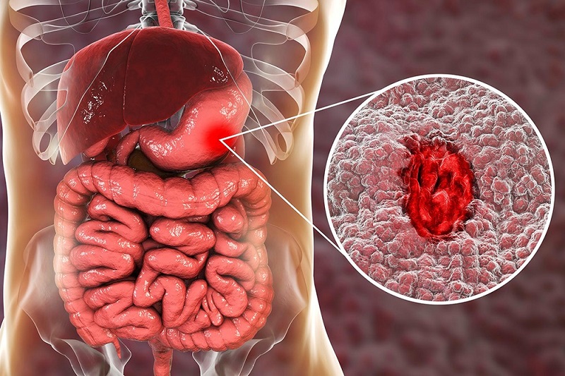 Quy trình điều trị viêm loét dạ dày tại Medlatec có gì đặc biệt?