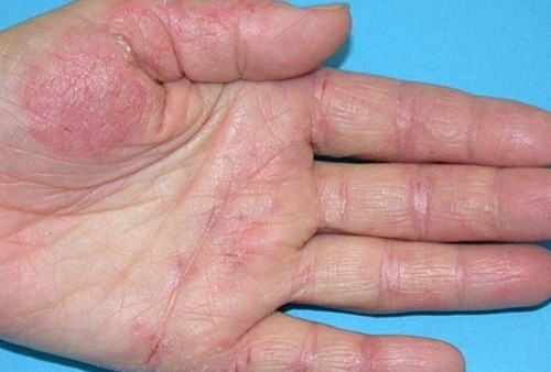 Quy trình chẩn đoán nấm da, viêm da cơ địa tại Thu Cúc