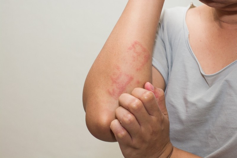 Giải pháp kiểm soát nổi mề đay mạn tính tại Thu Cúc