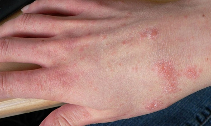 Da bị ngứa kéo dài – Vấn đề không nên chủ quan