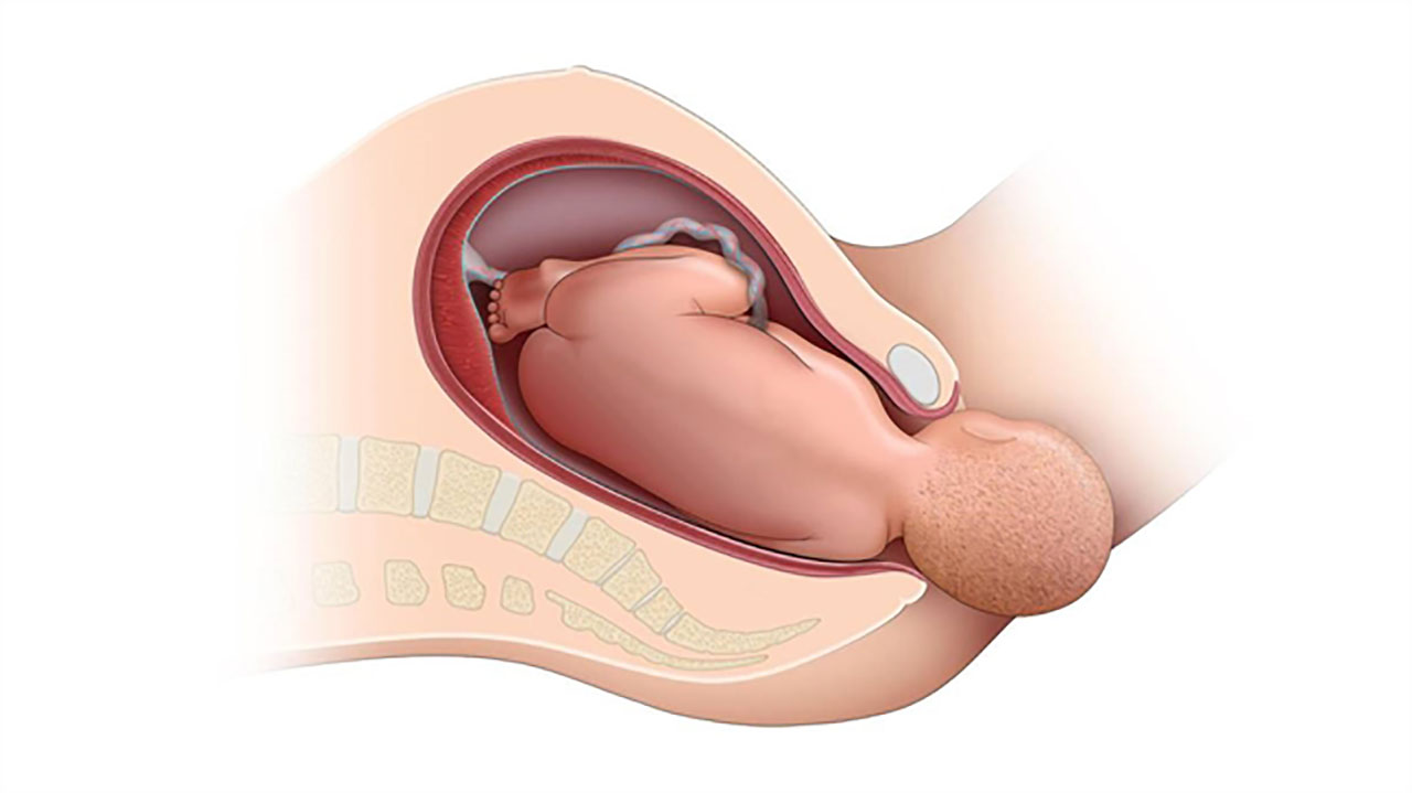 Sinh thường là gì?