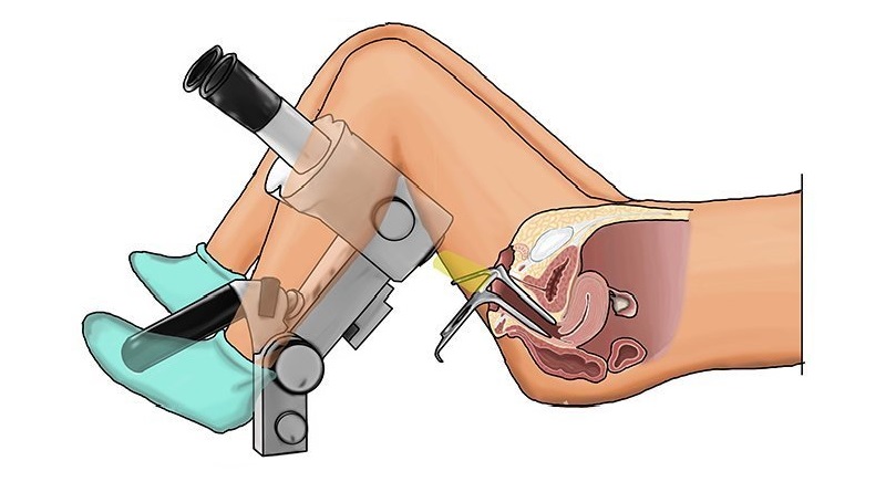 Ưu điểm khi soi cổ tử cung tại Thu Cúc