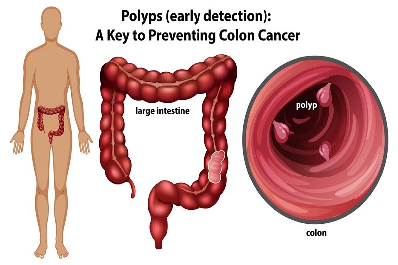Quy trình tầm soát polyp tại phòng khám Medlatec