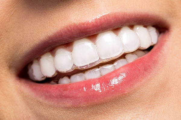 Điểm khác biệt khi niềng răng Invisalign tại MedDental