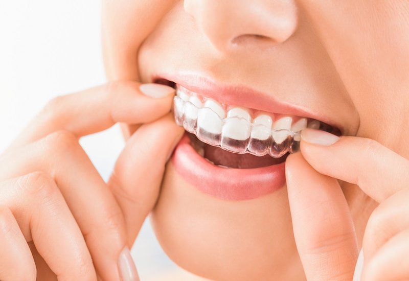 Điểm khác biệt khi niềng Invisalign tại MedDental