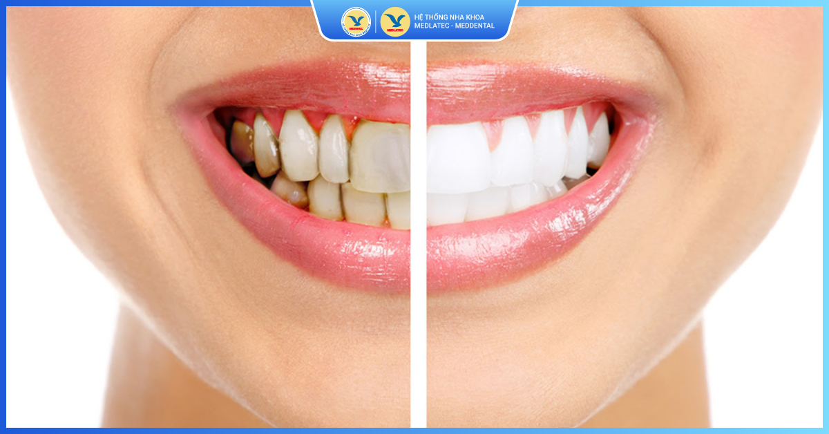 Tẩy trắng răng tại MedDental có gì khác biệt?