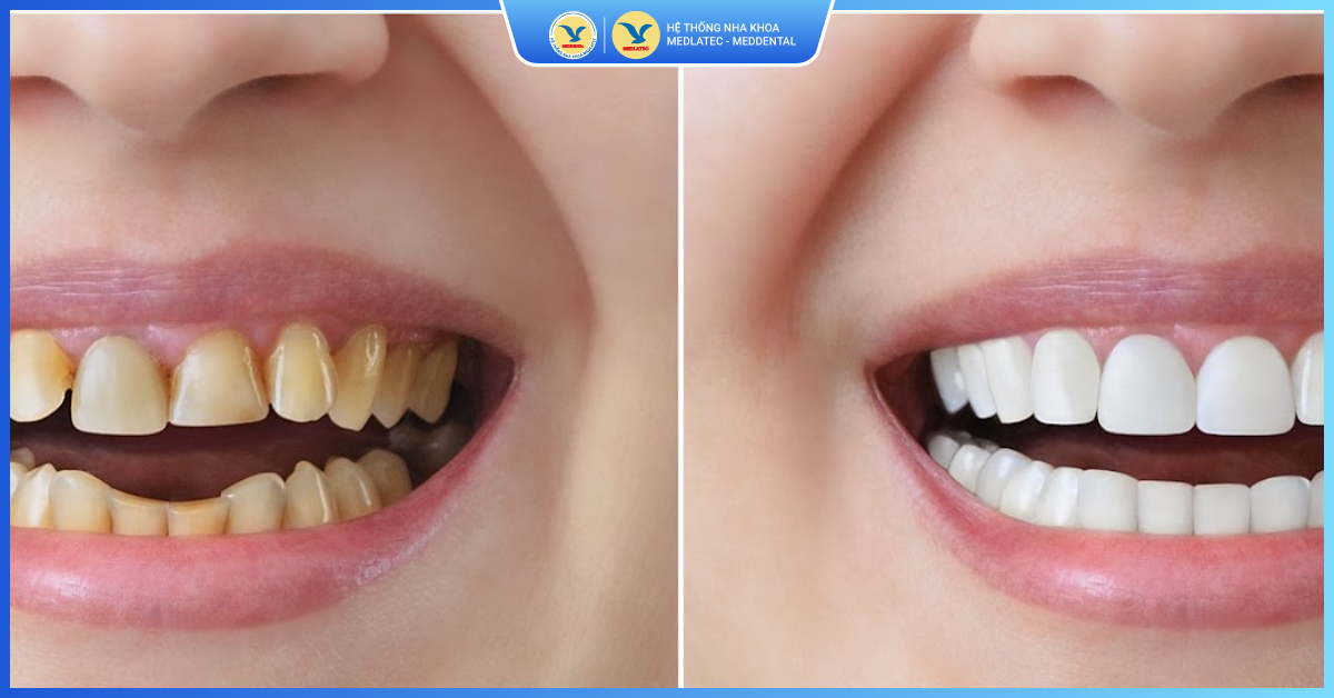 Bọc răng sứ thẩm mỹ tại MedDental – Bí quyết sở hữu nụ cười tự nhiên
