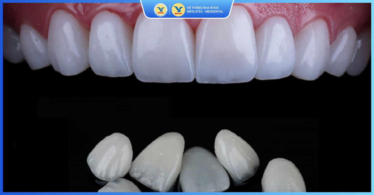 Ưu điểm khi dán sứ Veneer tại MedDental