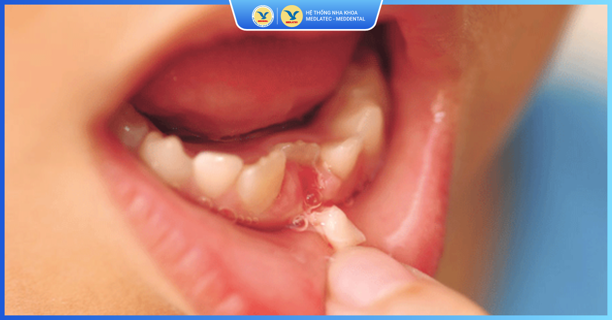 Vì sao cần nhổ răng sữa cho trẻ đúng thời điểm?