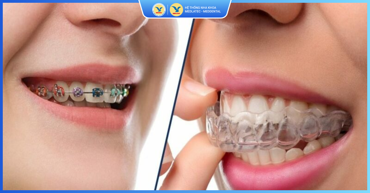 Invisalign – Giải pháp chỉnh nha hiện đại, thẩm mỹ