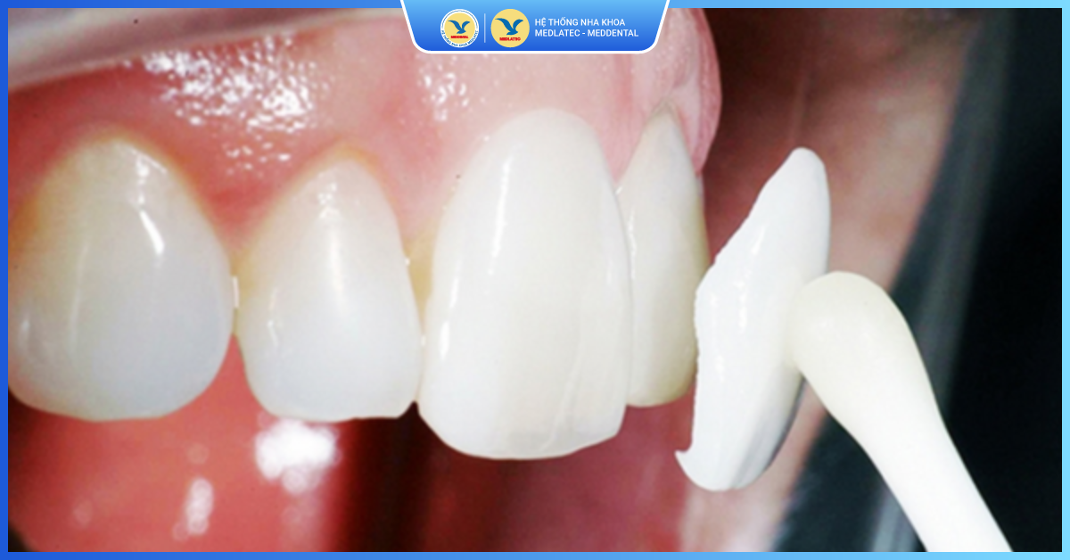 Dán sứ Veneer là gì?