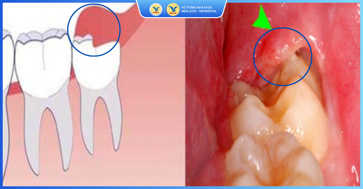 Quy trình cắt lợi trùm tại MedDental