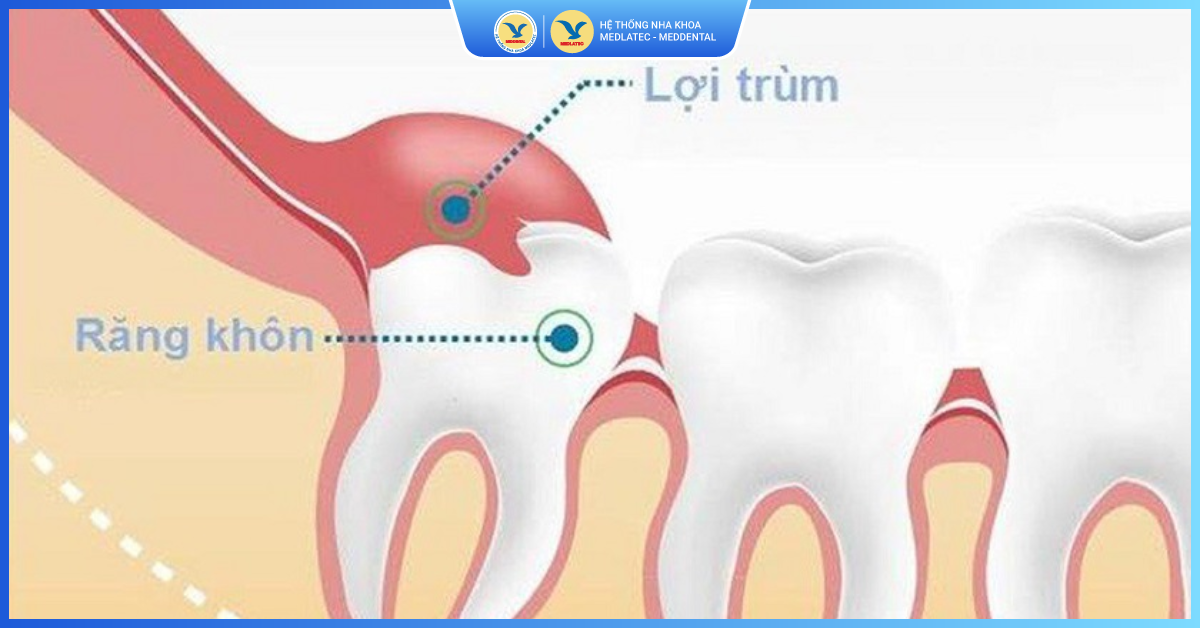 Lợi trùm răng khôn là gì?