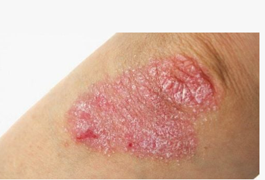 Đặt lịch Gói khám chẩn đoán bệnh vẩy nến tại BVĐK Quốc tế Vinmec I  Nhanh chóng, thuận tiện  I Đặt khám nhanh Online 