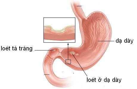 Bệnh lý dạ dày – tá tràng: Vấn đề sức khỏe không nên xem nhẹ