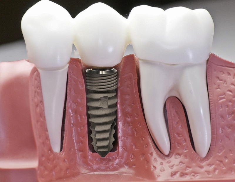 Quy trình cấy ghép Implant tại Thu Cúc