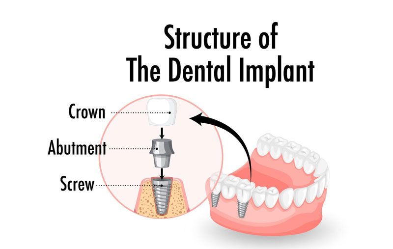 Dịch vụ bọc răng sứ thẩm mỹ