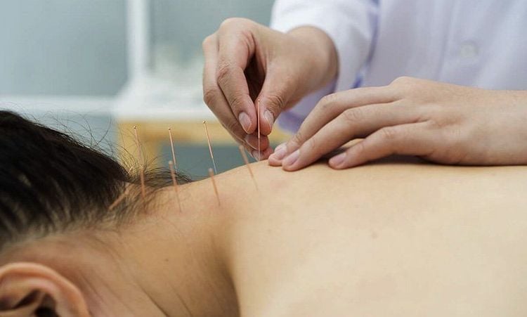 Quy trình châm cứu, bấm huyệt tại Thu Cúc