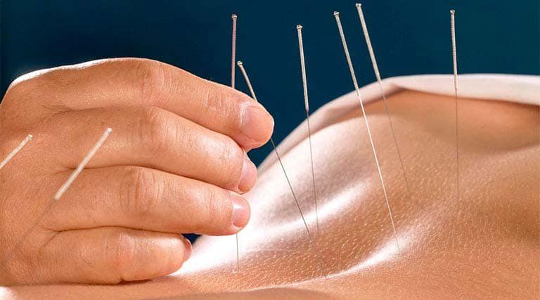 Vai trò của châm cứu, bấm huyệt trong chăm sóc sức khỏe