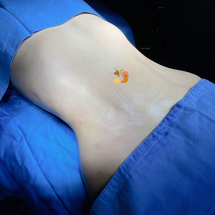 Quy trình tạo hình thành bụng tại Hồng Ngọc