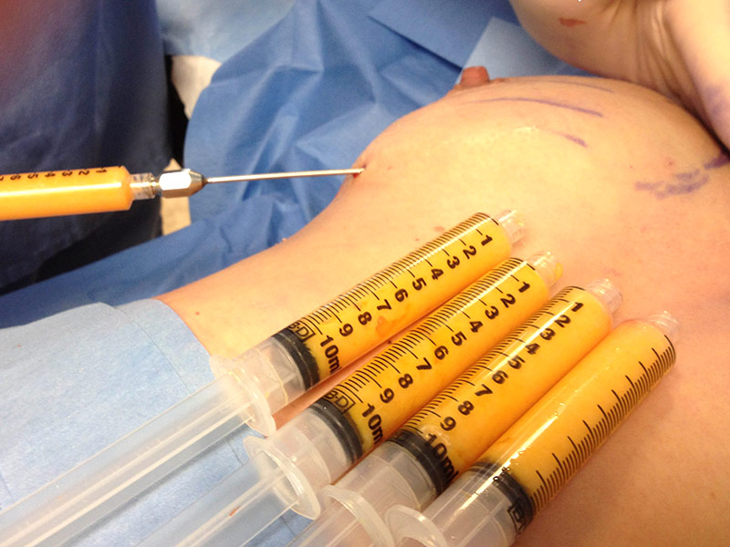 Tại sao nên chọn cấy mỡ tự thân tại Hồng Ngọc?