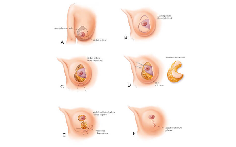 Hiện tượng ngực sa trễ và nguyên nhân