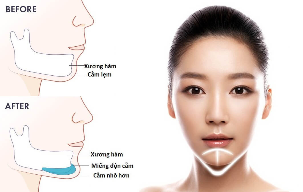Tầm quan trọng của nội soi trong chẩn đoán và điều trị bệnh lý dạ dày