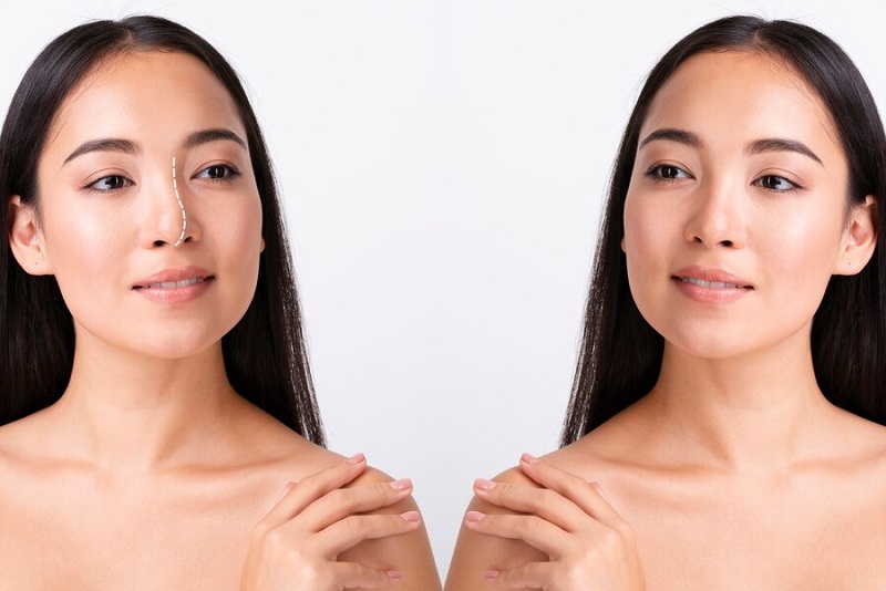 Những ai phù hợp với nâng mũi cấu trúc?