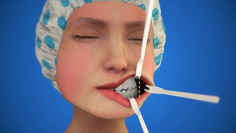 Gọt hàm V-line – Xu hướng làm đẹp hiện đại