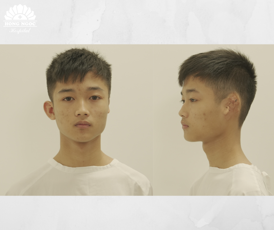 Ưu điểm nổi bật khi phẫu thuật tạo hình tai tại Hồng Ngọc