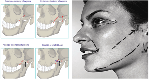 Hạ gò má – Xu hướng làm đẹp để gương mặt hài hòa hơn